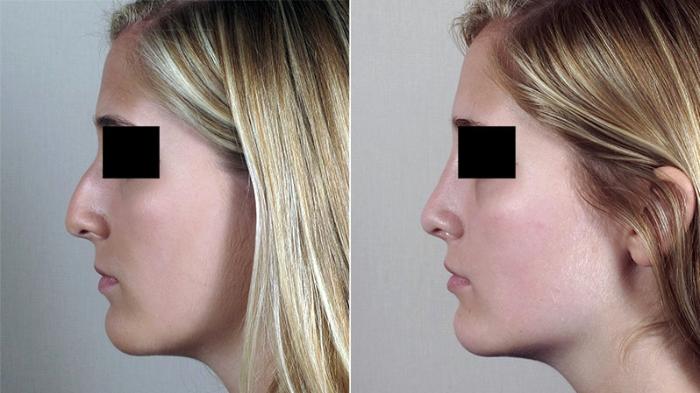 Rhinoplasty Case 187 Before & After View #1 | Paramus, New Jersey | Parker Center for Plastic Surgery