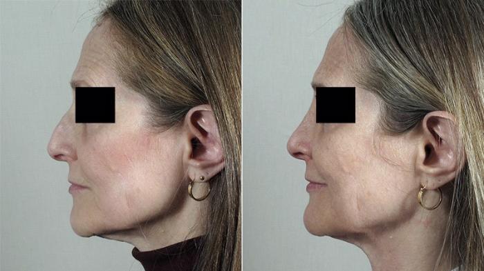 Rhinoplasty Case 188 Before & After View #1 | Paramus, New Jersey | Parker Center for Plastic Surgery