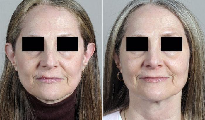 Rhinoplasty Case 188 Before & After View #2 | Paramus, New Jersey | Parker Center for Plastic Surgery