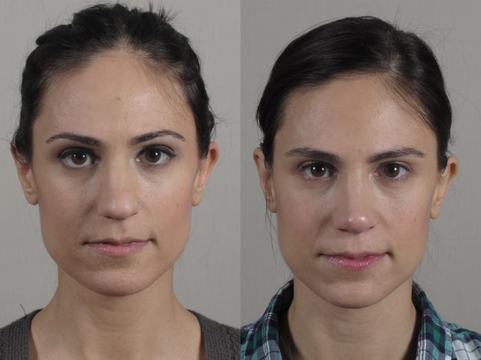 Rhinoplasty Case 189 Before & After Front | Paramus, New Jersey | Parker Center for Plastic Surgery