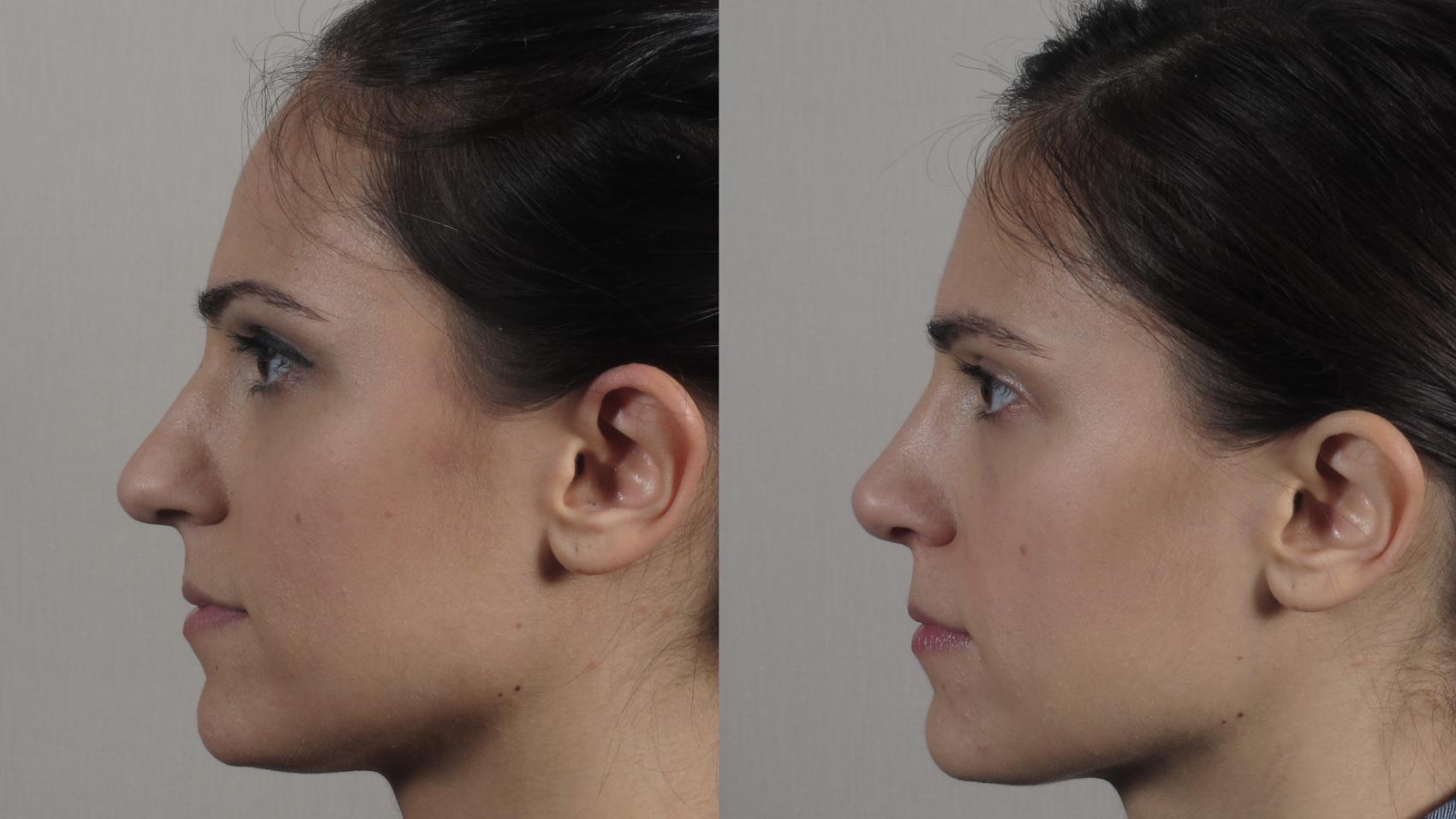 Rhinoplasty Case 189 Before & After Right Side | Paramus, New Jersey | Parker Center for Plastic Surgery