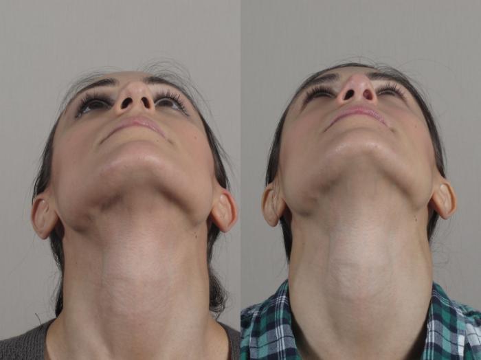 Rhinoplasty Case 189 Before & After Worms eye | Paramus, New Jersey | Parker Center for Plastic Surgery