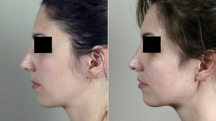 Rhinoplasty Case 190 Before & After View #1 | Paramus, New Jersey | Parker Center for Plastic Surgery