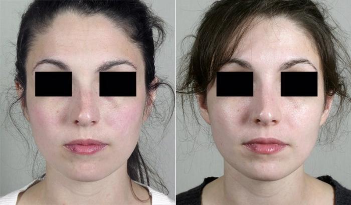 Rhinoplasty Case 190 Before & After View #2 | Paramus, New Jersey | Parker Center for Plastic Surgery