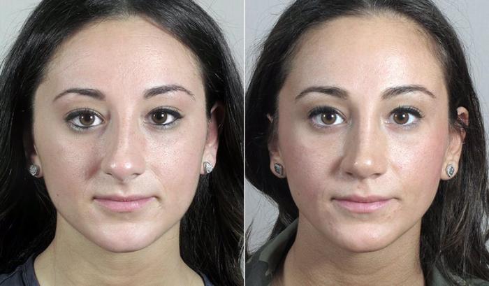 Rhinoplasty Case 191 Before & After View #1 | Paramus, New Jersey | Parker Center for Plastic Surgery