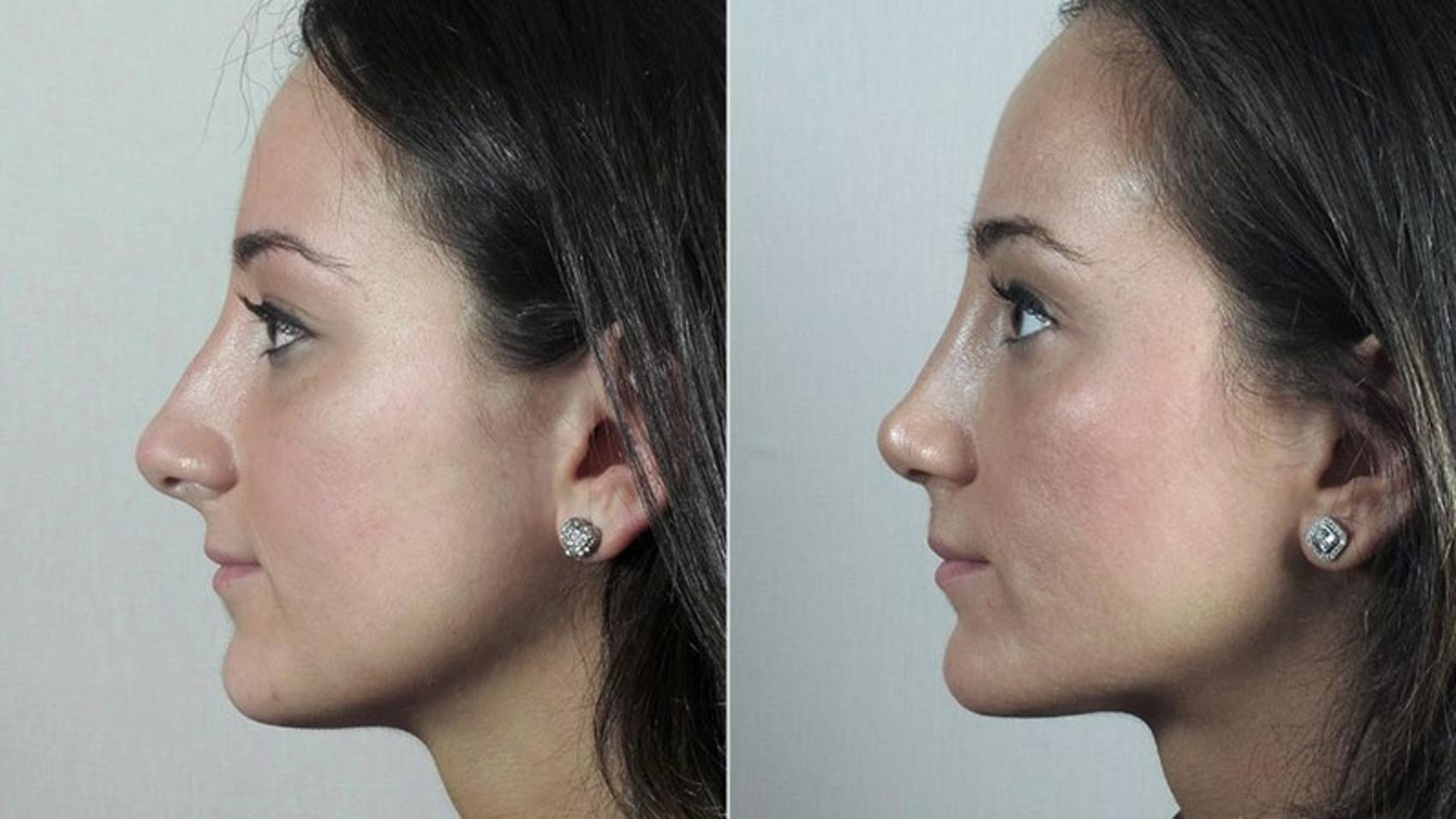 Rhinoplasty Case 191 Before & After View #2 | Paramus, New Jersey | Parker Center for Plastic Surgery