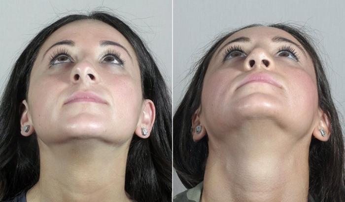 Rhinoplasty Case 191 Before & After View #3 | Paramus, New Jersey | Parker Center for Plastic Surgery