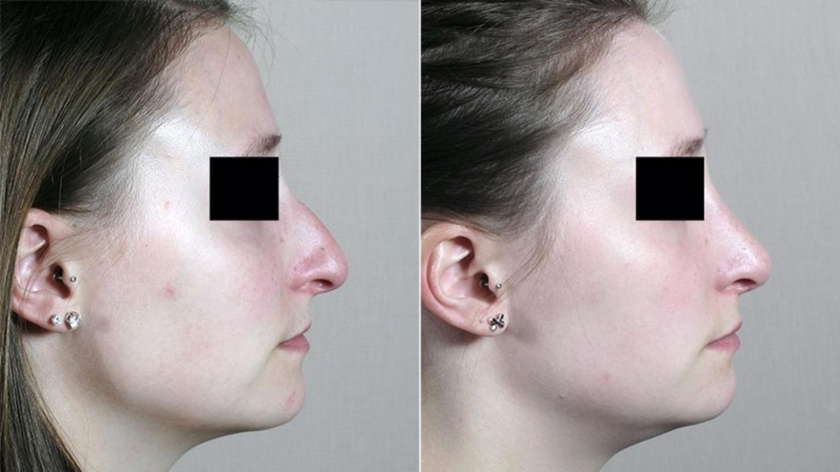 Rhinoplasty Case 192 Before & After View #1 | Paramus, New Jersey | Parker Center for Plastic Surgery