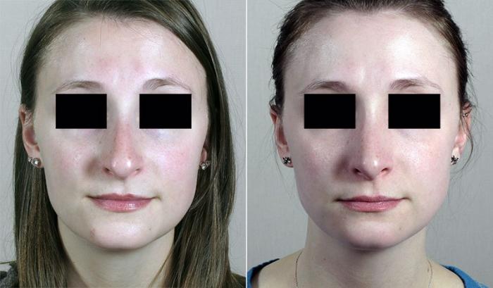 Rhinoplasty Case 192 Before & After View #2 | Paramus, New Jersey | Parker Center for Plastic Surgery