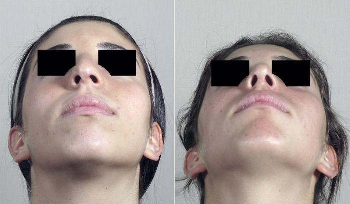 Rhinoplasty Case 193 Before & After View #1 | Paramus, New Jersey | Parker Center for Plastic Surgery