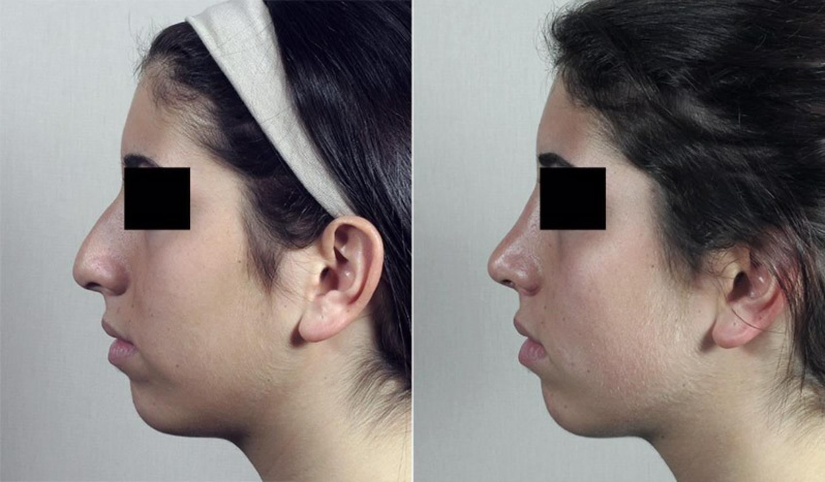 Rhinoplasty Case 193 Before & After View #2 | Paramus, New Jersey | Parker Center for Plastic Surgery