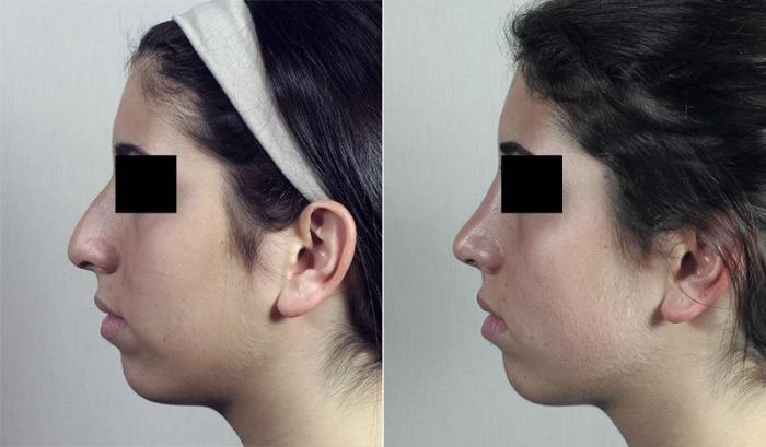 Rhinoplasty Case 193 Before & After View #2 | Paramus, New Jersey | Parker Center for Plastic Surgery