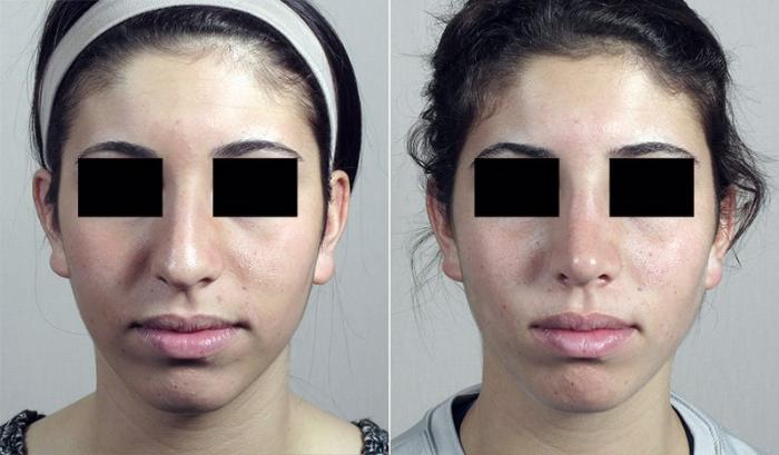 Rhinoplasty Case 193 Before & After View #3 | Paramus, New Jersey | Parker Center for Plastic Surgery