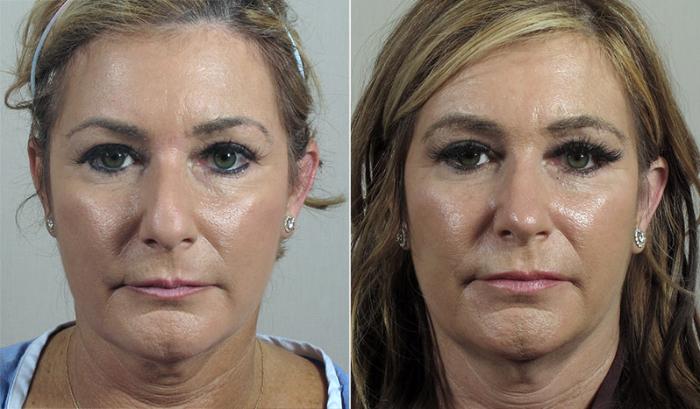 Rhinoplasty Case 194 Before & After View #1 | Paramus, New Jersey | Parker Center for Plastic Surgery