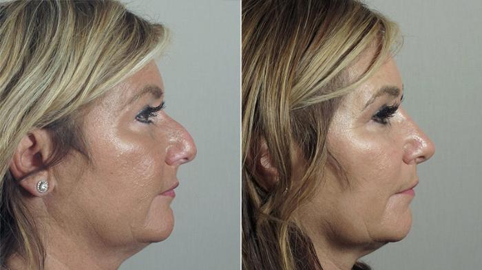 Rhinoplasty Case 194 Before & After View #2 | Paramus, New Jersey | Parker Center for Plastic Surgery