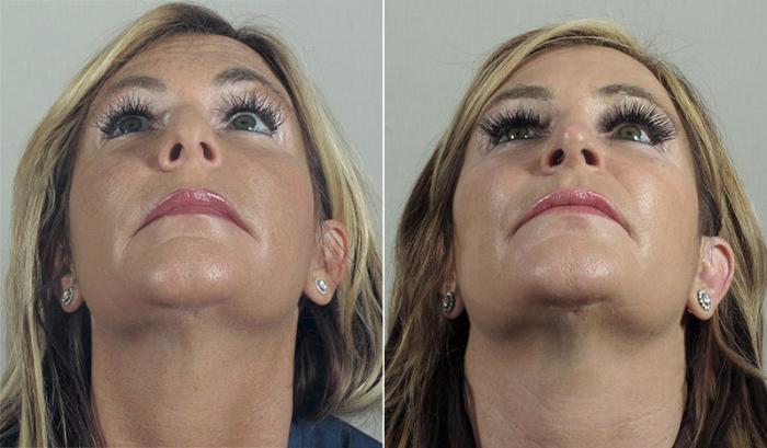 Rhinoplasty Case 194 Before & After View #3 | Paramus, New Jersey | Parker Center for Plastic Surgery