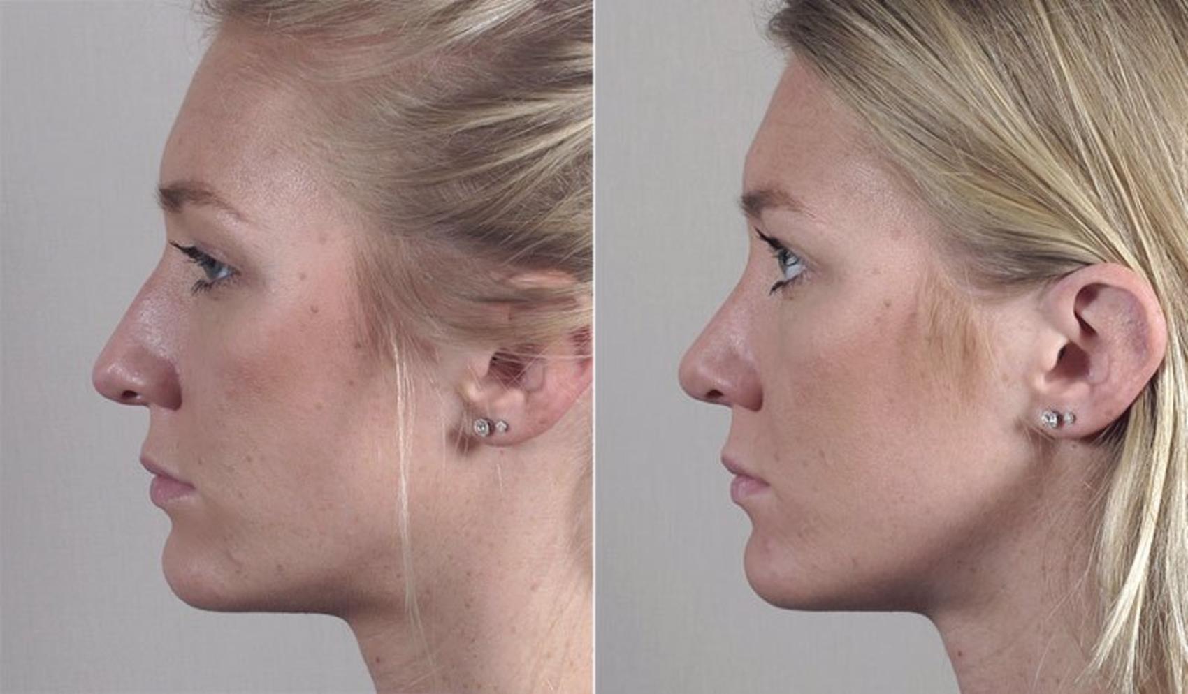 Rhinoplasty Case 195 Before & After View #1 | Paramus, New Jersey | Parker Center for Plastic Surgery