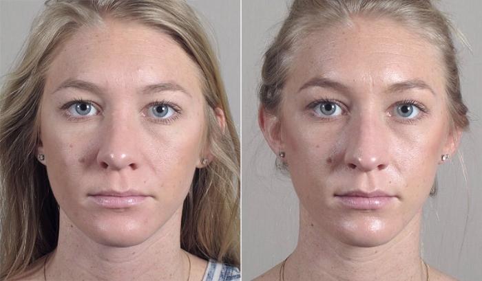 Rhinoplasty Case 195 Before & After View #2 | Paramus, New Jersey | Parker Center for Plastic Surgery