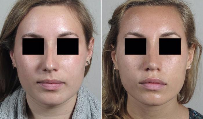 Rhinoplasty Case 196 Before & After View #1 | Paramus, New Jersey | Parker Center for Plastic Surgery