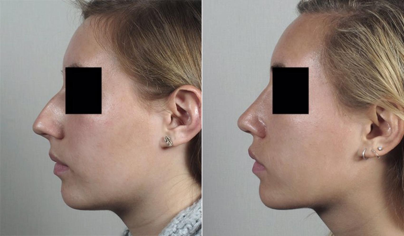 Rhinoplasty Case 196 Before & After View #2 | Paramus, New Jersey | Parker Center for Plastic Surgery