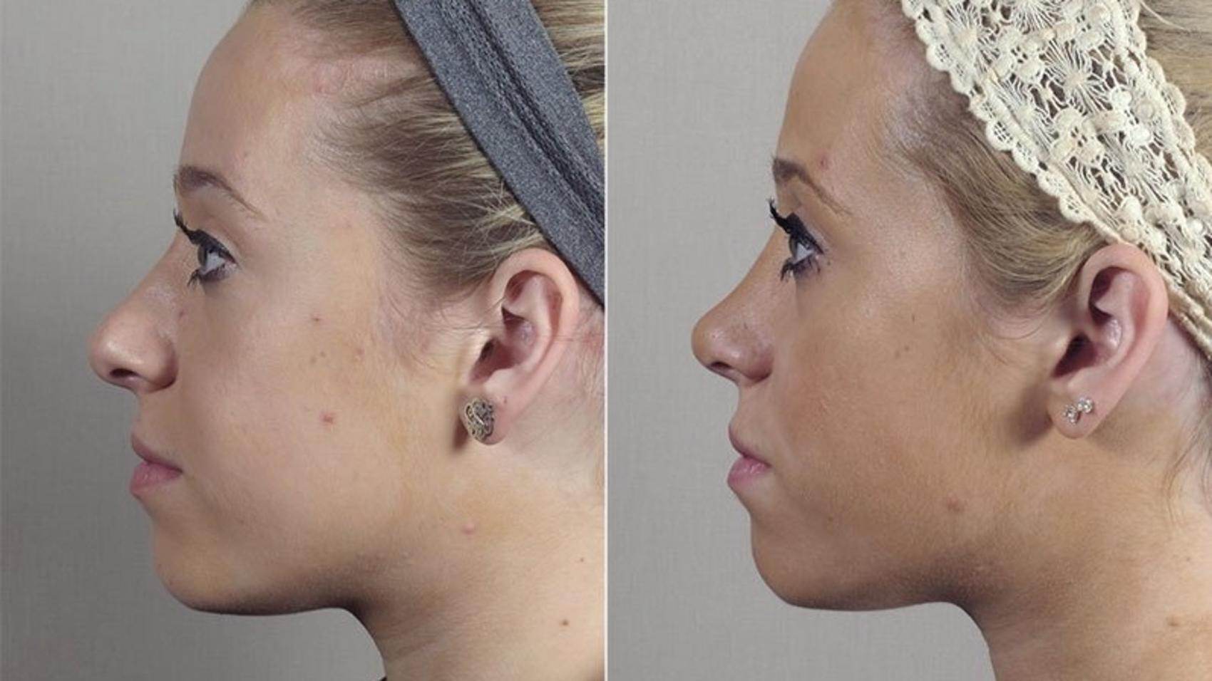Rhinoplasty Case 197 Before & After View #1 | Paramus, New Jersey | Parker Center for Plastic Surgery