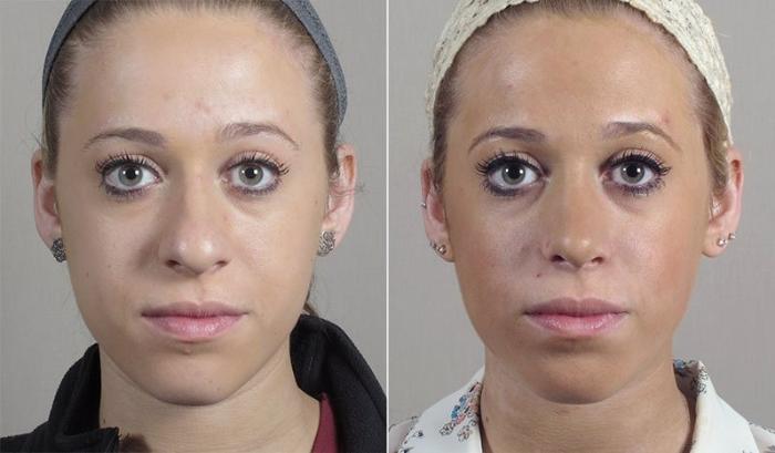 Rhinoplasty Case 197 Before & After View #2 | Paramus, New Jersey | Parker Center for Plastic Surgery