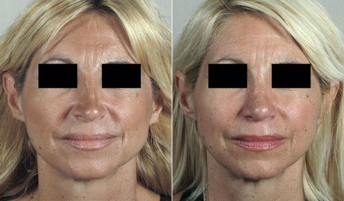 Rhinoplasty Case 198 Before & After View #1 | Paramus, New Jersey | Parker Center for Plastic Surgery