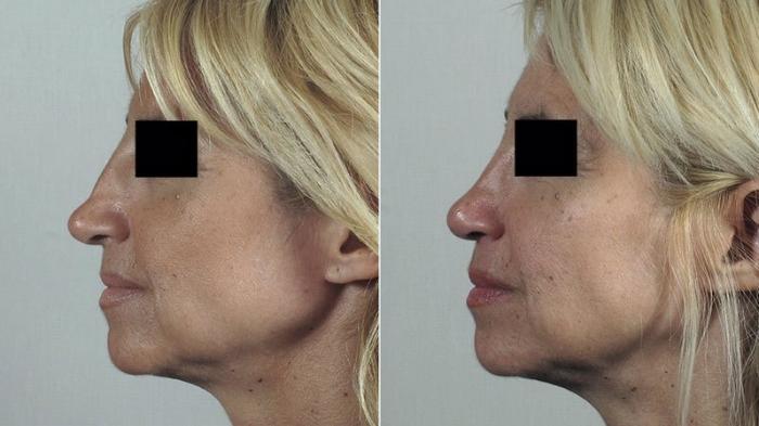 Rhinoplasty Case 198 Before & After View #2 | Paramus, New Jersey | Parker Center for Plastic Surgery