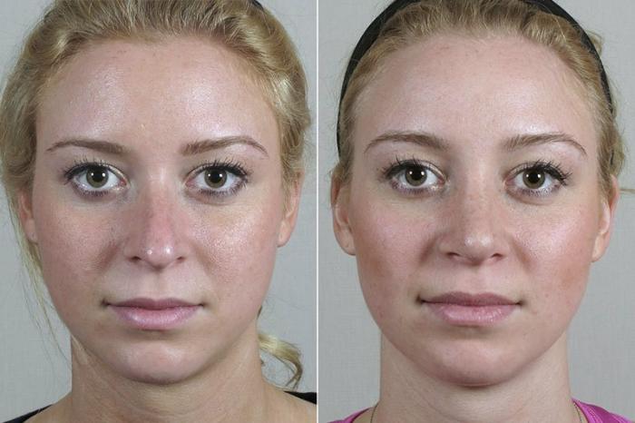 Rhinoplasty Case 199 Before & After View #1 | Paramus, New Jersey | Parker Center for Plastic Surgery