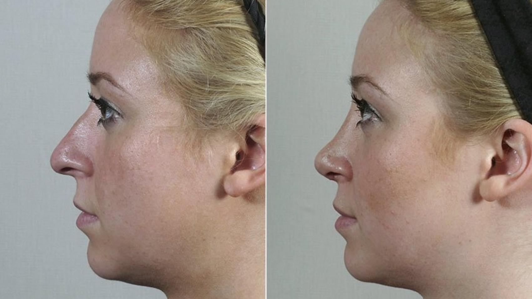 Rhinoplasty Case 199 Before & After View #2 | Paramus, New Jersey | Parker Center for Plastic Surgery