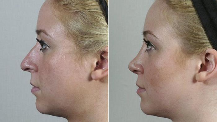 Rhinoplasty Case 199 Before & After View #2 | Paramus, New Jersey | Parker Center for Plastic Surgery