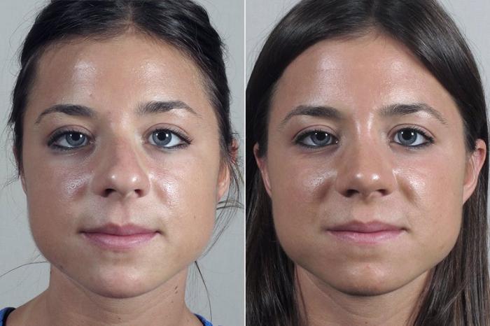 Rhinoplasty Case 200 Before & After View #1 | Paramus, New Jersey | Parker Center for Plastic Surgery