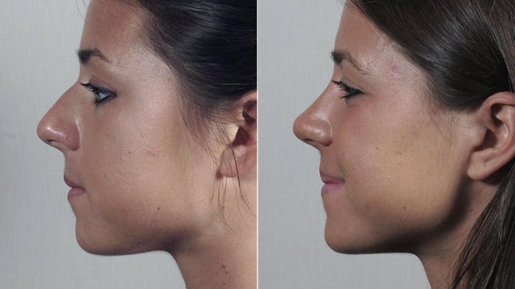 Rhinoplasty Case 200 Before & After View #2 | Paramus, New Jersey | Parker Center for Plastic Surgery