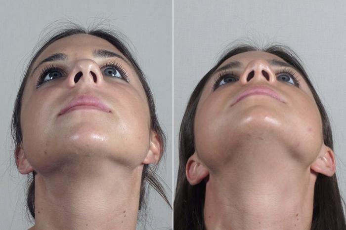 Rhinoplasty Case 200 Before & After View #3 | Paramus, New Jersey | Parker Center for Plastic Surgery