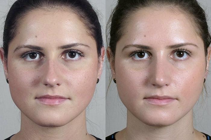 Rhinoplasty Case 201 Before & After View #1 | Paramus, New Jersey | Parker Center for Plastic Surgery
