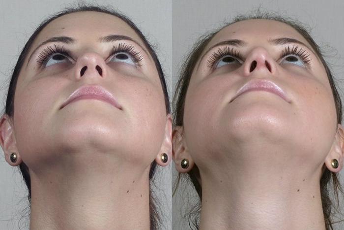 Rhinoplasty Case 201 Before & After View #3 | Paramus, New Jersey | Parker Center for Plastic Surgery