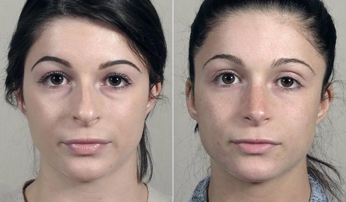 Rhinoplasty Case 202 Before & After View #1 | Paramus, New Jersey | Parker Center for Plastic Surgery