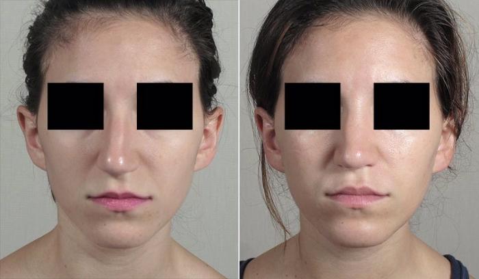 Rhinoplasty Case 203 Before & After View #1 | Paramus, New Jersey | Parker Center for Plastic Surgery