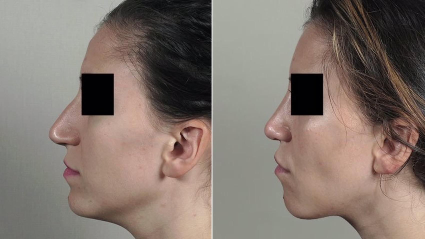 Rhinoplasty Case 203 Before & After View #2 | Paramus, New Jersey | Parker Center for Plastic Surgery