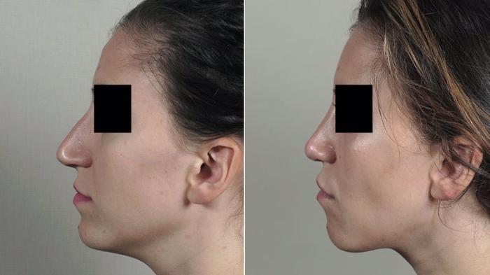 Rhinoplasty Case 203 Before & After View #2 | Paramus, New Jersey | Parker Center for Plastic Surgery