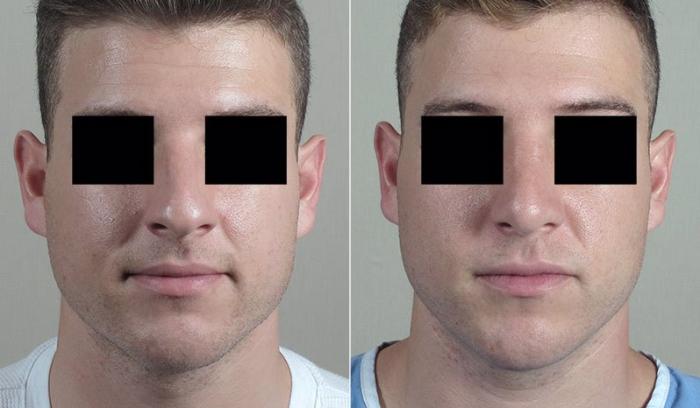 Rhinoplasty Case 204 Before & After View #1 | Paramus, New Jersey | Parker Center for Plastic Surgery