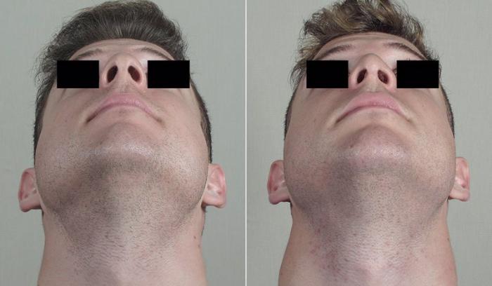 Rhinoplasty Case 204 Before & After View #3 | Paramus, New Jersey | Parker Center for Plastic Surgery
