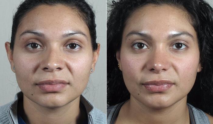 Rhinoplasty Case 205 Before & After View #1 | Paramus, New Jersey | Parker Center for Plastic Surgery