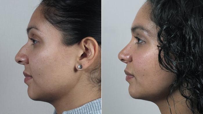 Rhinoplasty Case 205 Before & After View #2 | Paramus, New Jersey | Parker Center for Plastic Surgery