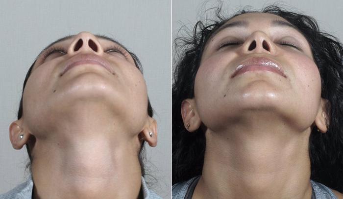 Rhinoplasty Case 205 Before & After View #3 | Paramus, New Jersey | Parker Center for Plastic Surgery