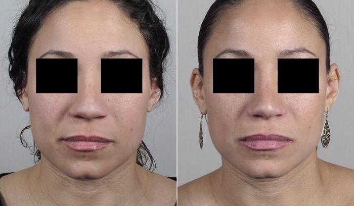 Rhinoplasty Case 206 Before & After View #1 | Paramus, New Jersey | Parker Center for Plastic Surgery