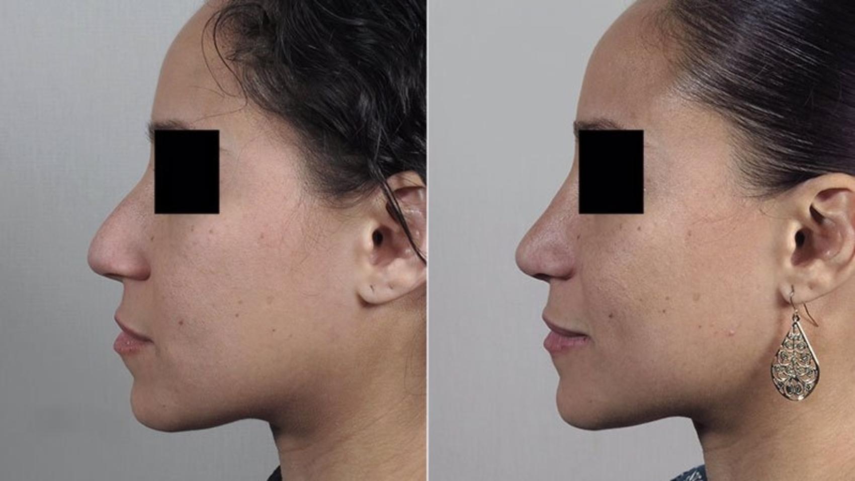 Rhinoplasty Case 206 Before & After View #2 | Paramus, New Jersey | Parker Center for Plastic Surgery