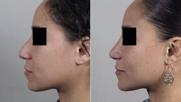Rhinoplasty Case 206 Before & After View #2 | Paramus, New Jersey | Parker Center for Plastic Surgery