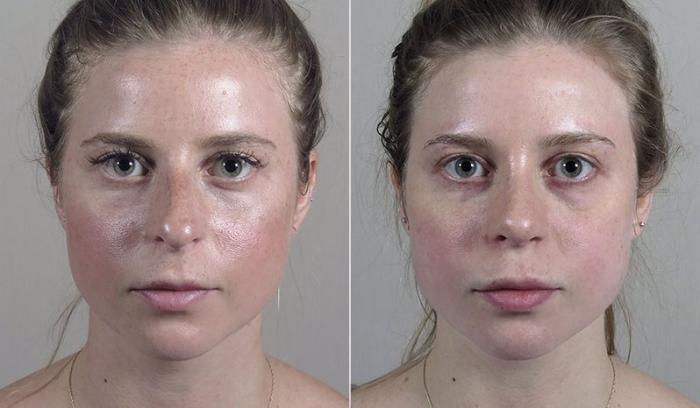 Rhinoplasty Case 207 Before & After View #1 | Paramus, New Jersey | Parker Center for Plastic Surgery