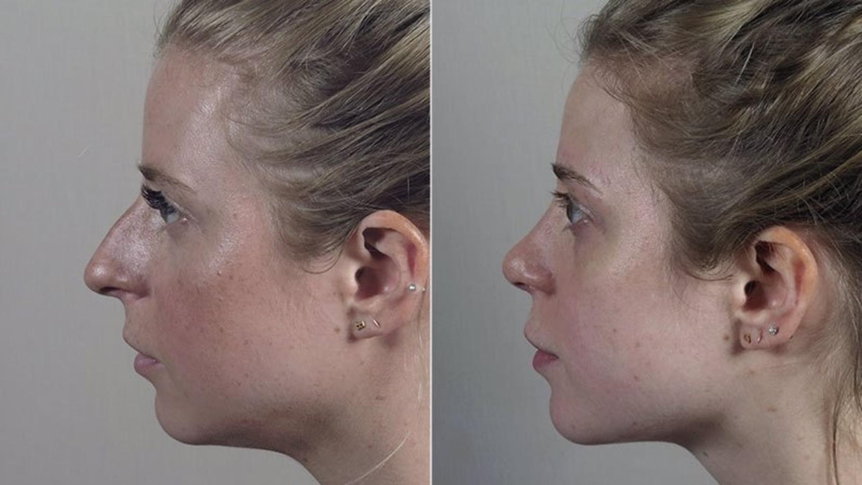 Rhinoplasty Case 207 Before & After View #2 | Paramus, New Jersey | Parker Center for Plastic Surgery